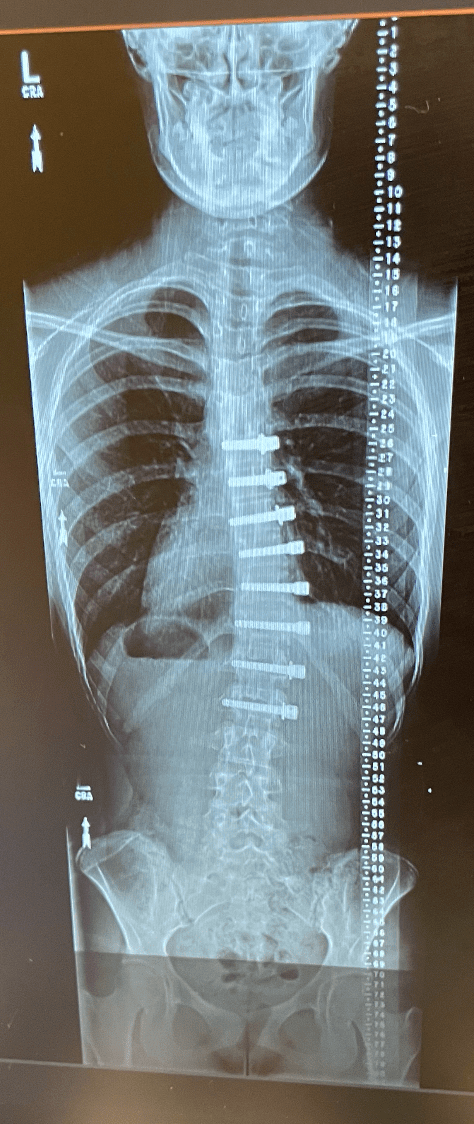 My X-Rays – My Scoliosis Journey